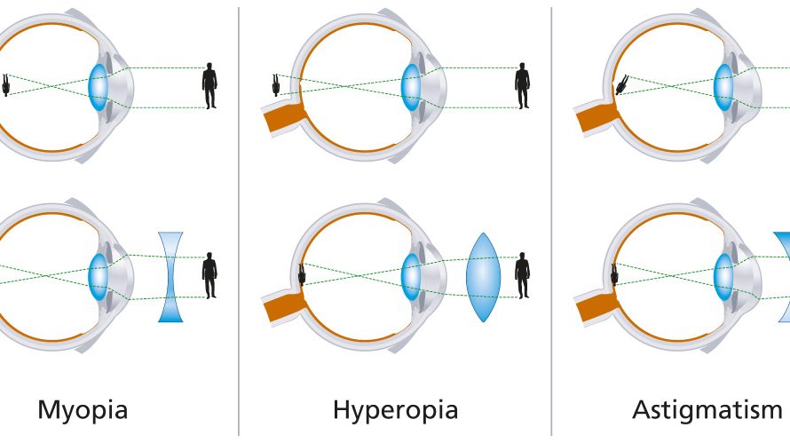 Emmetropia-Ametropia-Refractyyive-error