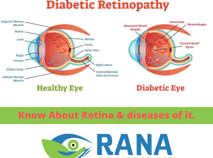 Know About Retina & diseases of it.