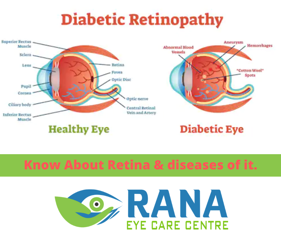 Know About Retina & diseases of it.